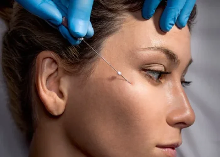 threadlift
